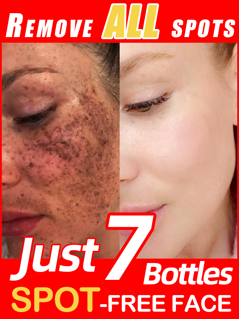 Luxury Skincare Essence - Zmniejszanie piegów, melazmy, ciemnych plam na